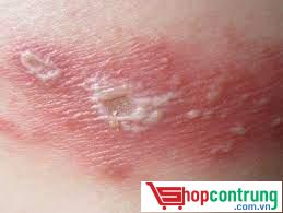 bị kiến ba khoang cắn