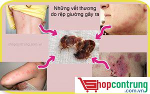 Vết cắn của rệp
